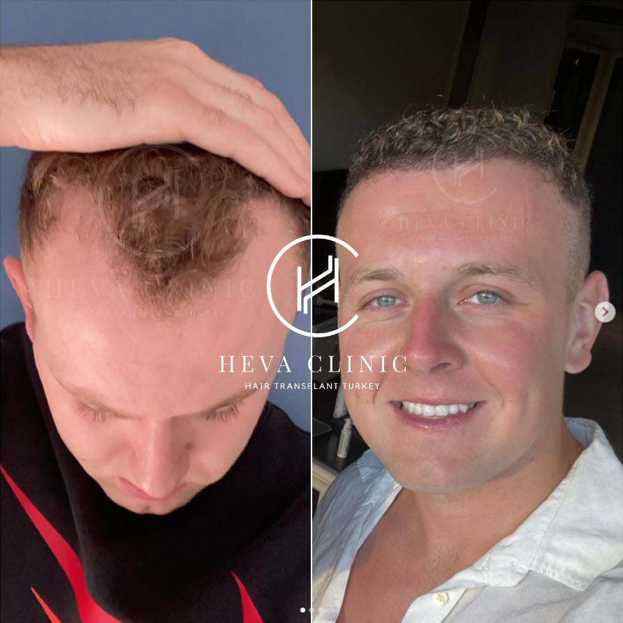 2956 grafts receding hairline hair transplant before and after result