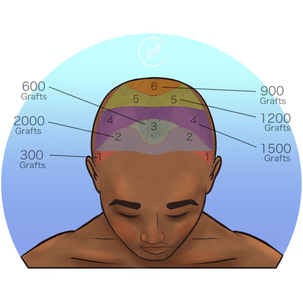 Allocation of grafts on the scalp for hair transplant - afro male