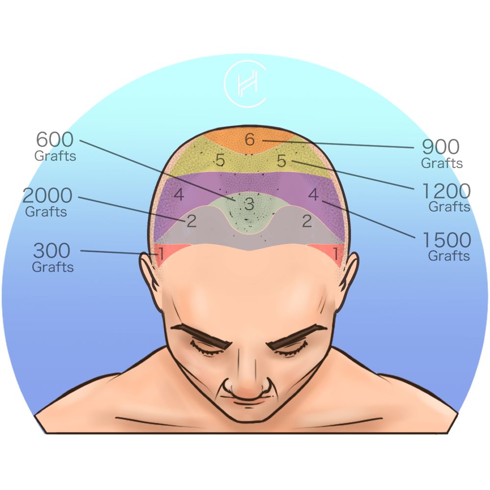 Allocation of grafts on the scalp for hair transplant - male Allocation of grafts on the scalp for hair transplant - male