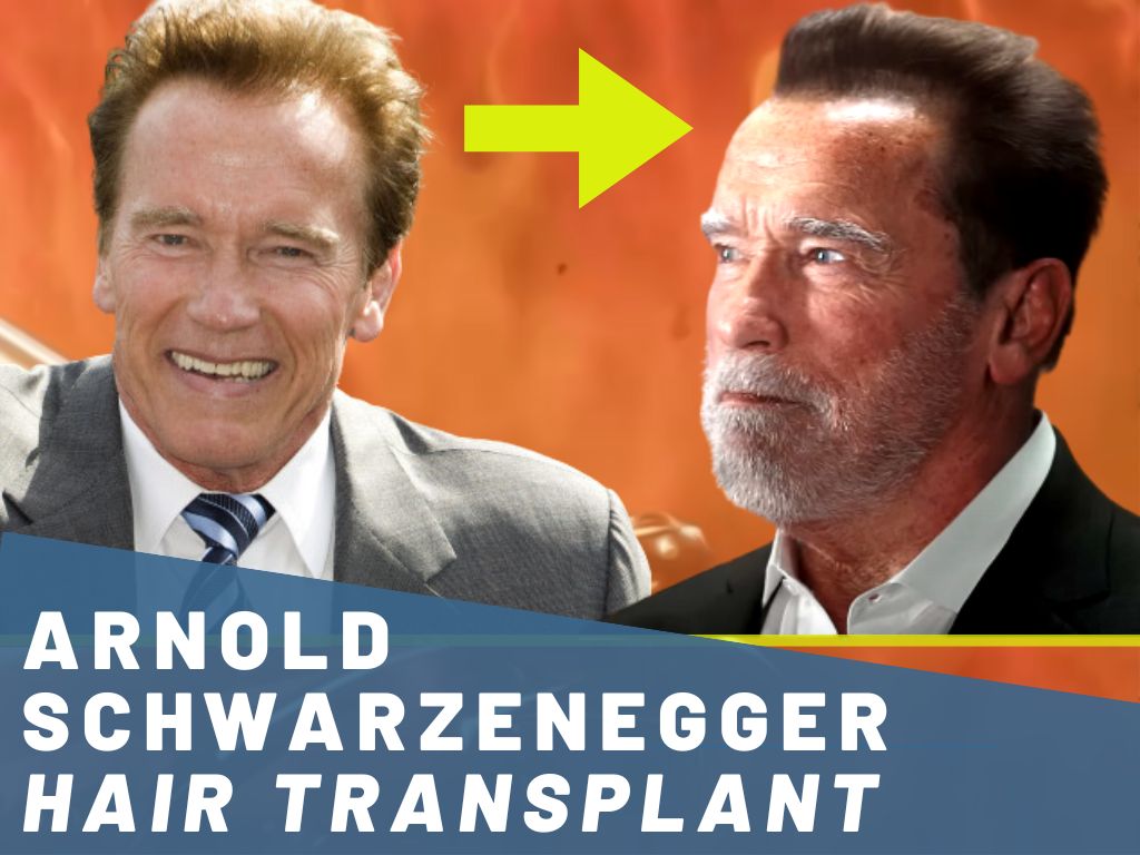 Arnold Schwarzenegger - Hair Transplant Analysis Banner
