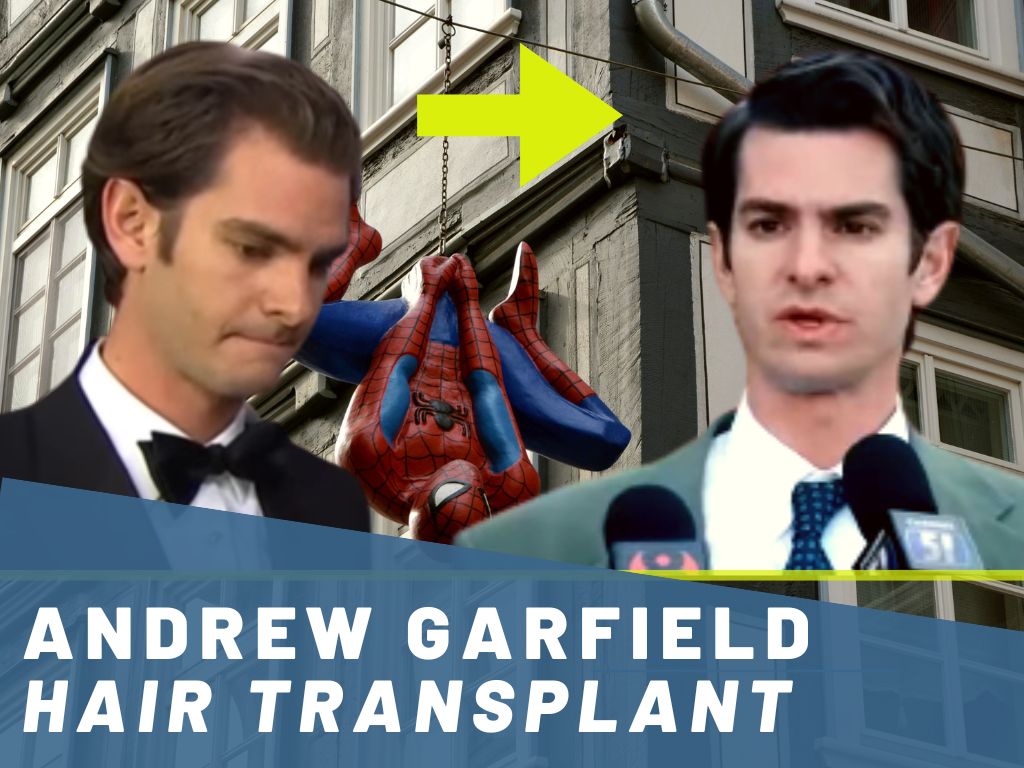 andrew garfield - hair transplant analysis banner