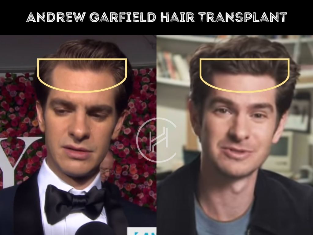 andrew garfield hair transplant before after