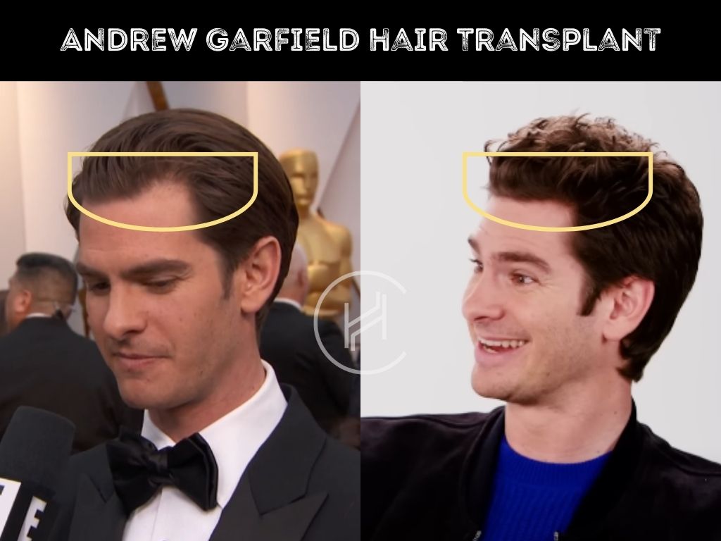 andrew garfield hair transplant before & after