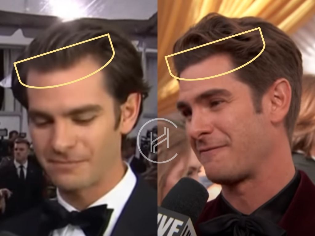 andrew garfield - hair transplant before and after result