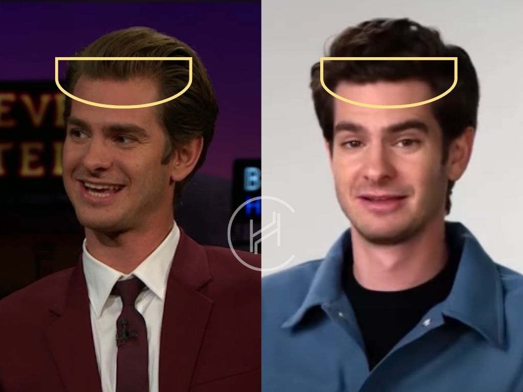 andrew garfield - hair transplant before and after