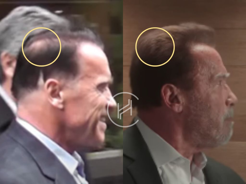 arnold schwarzenegger - hair transplant before after result