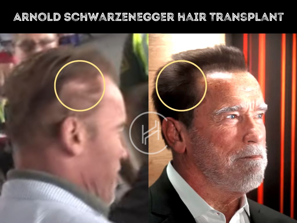 arnold schwarzenegger - hair transplant before and after result