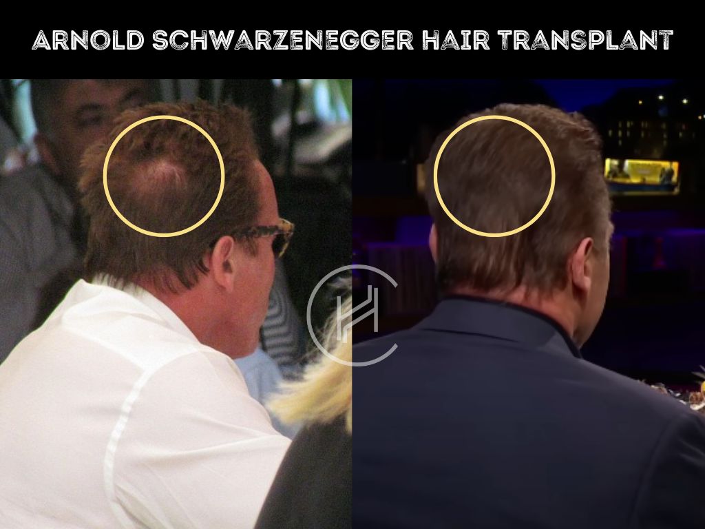 arnold schwarzenegger hair transplant before and after
