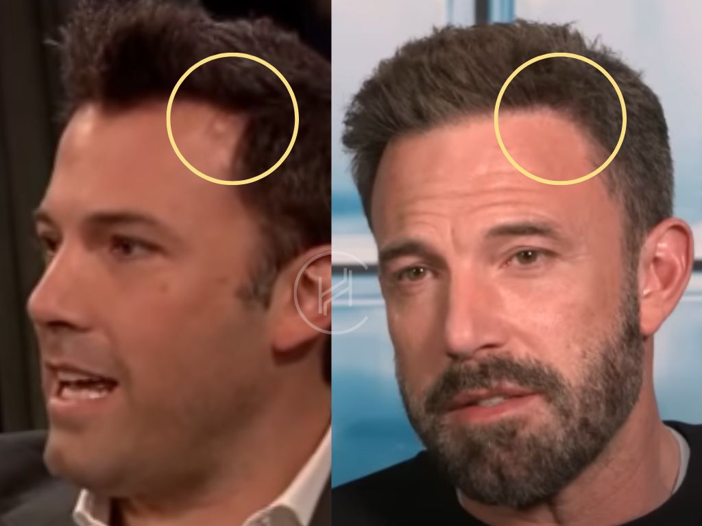 ben affleck - hair transplant before after widow's peak