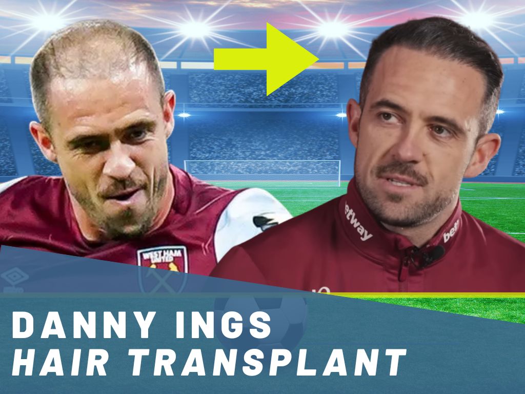 danny ings hair transplant analysis banner