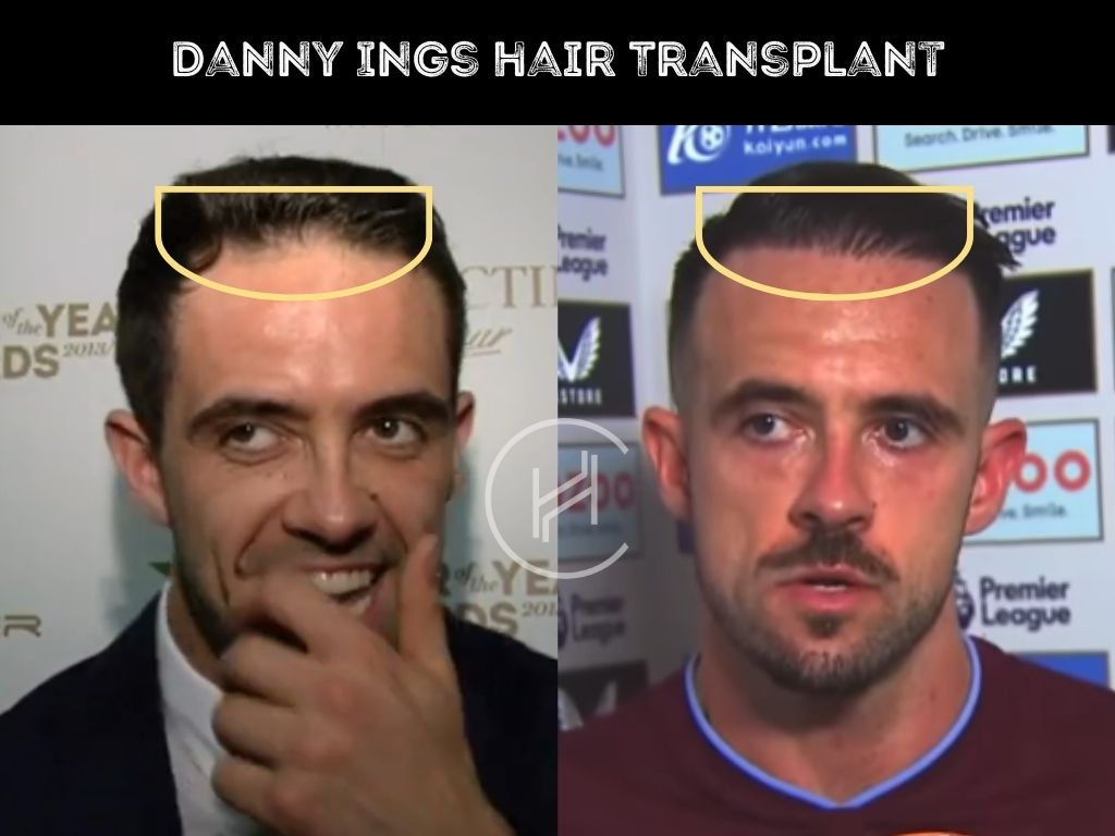 danny ings hair transplant before after result