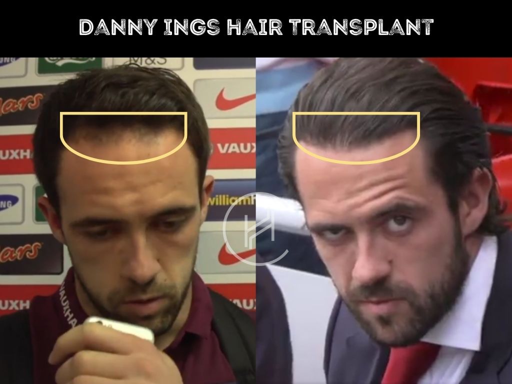 danny ings - hair transplant before & after