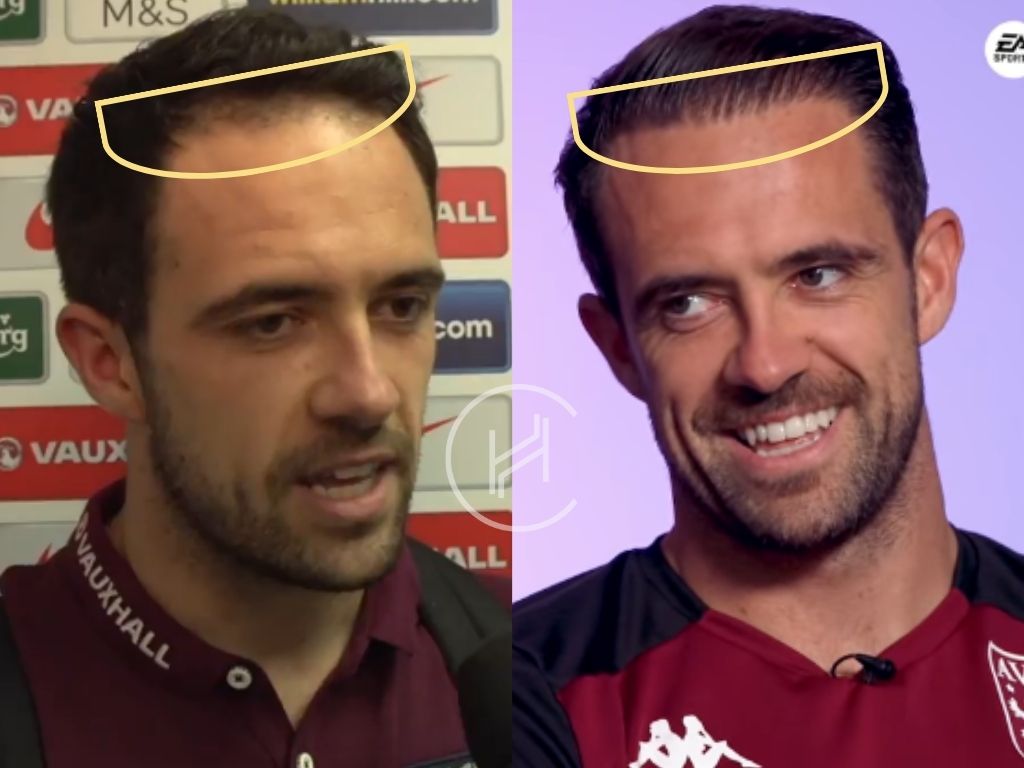 danny ings hair transplant before and after result