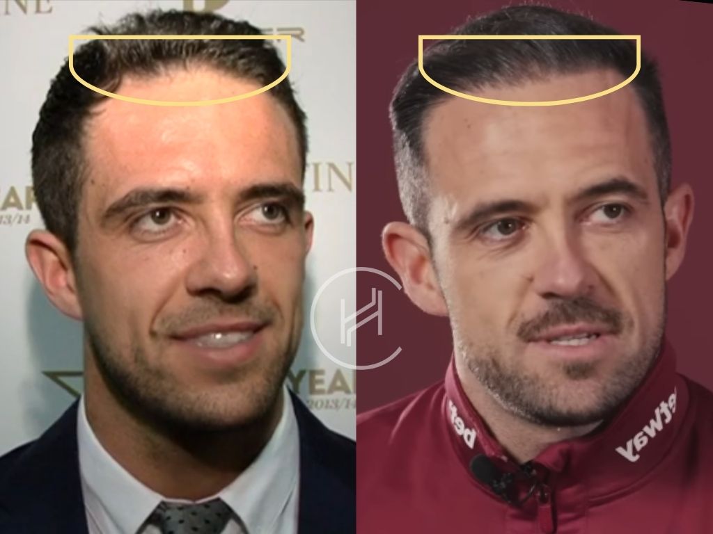 danny ings hair transplant before and after