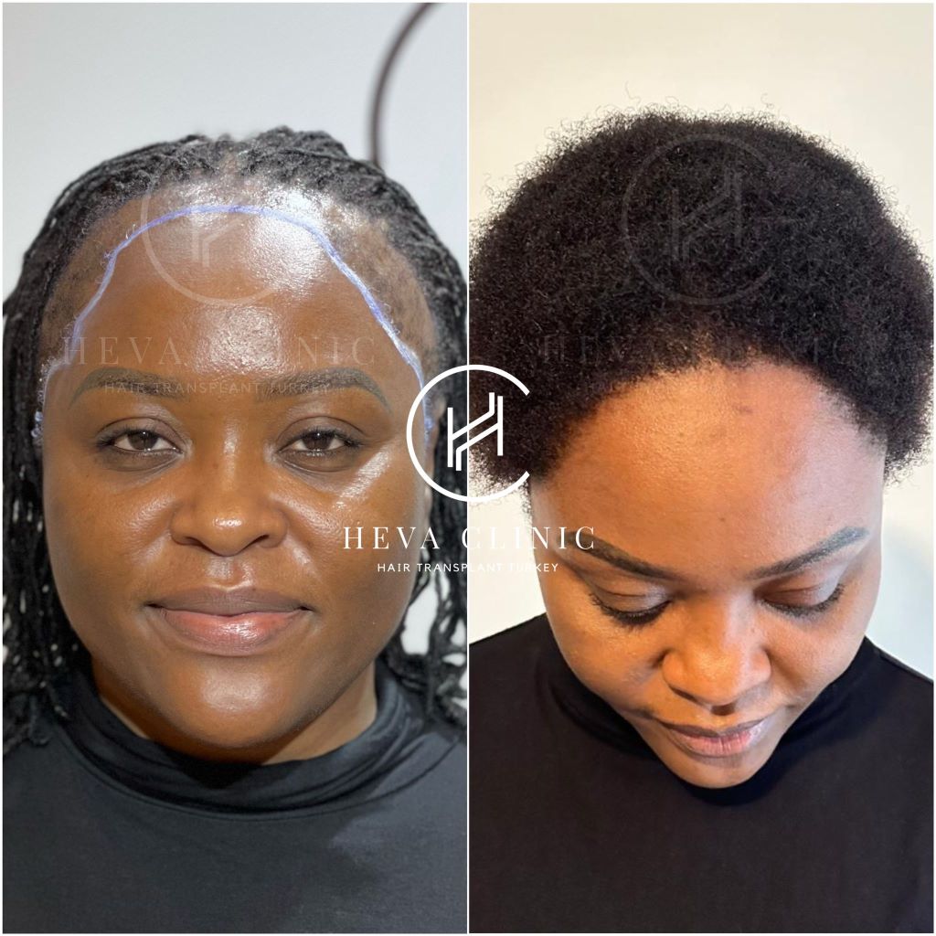 female afro hair transplant hairline 3500 grafts