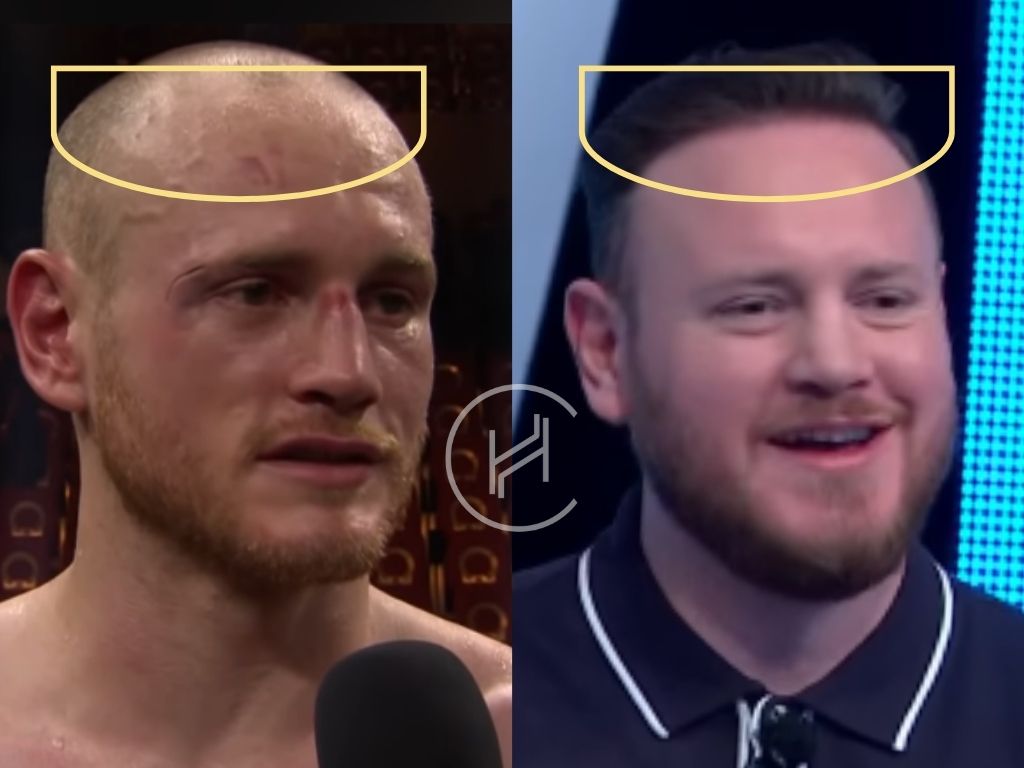 george groves - hair transplant before after result