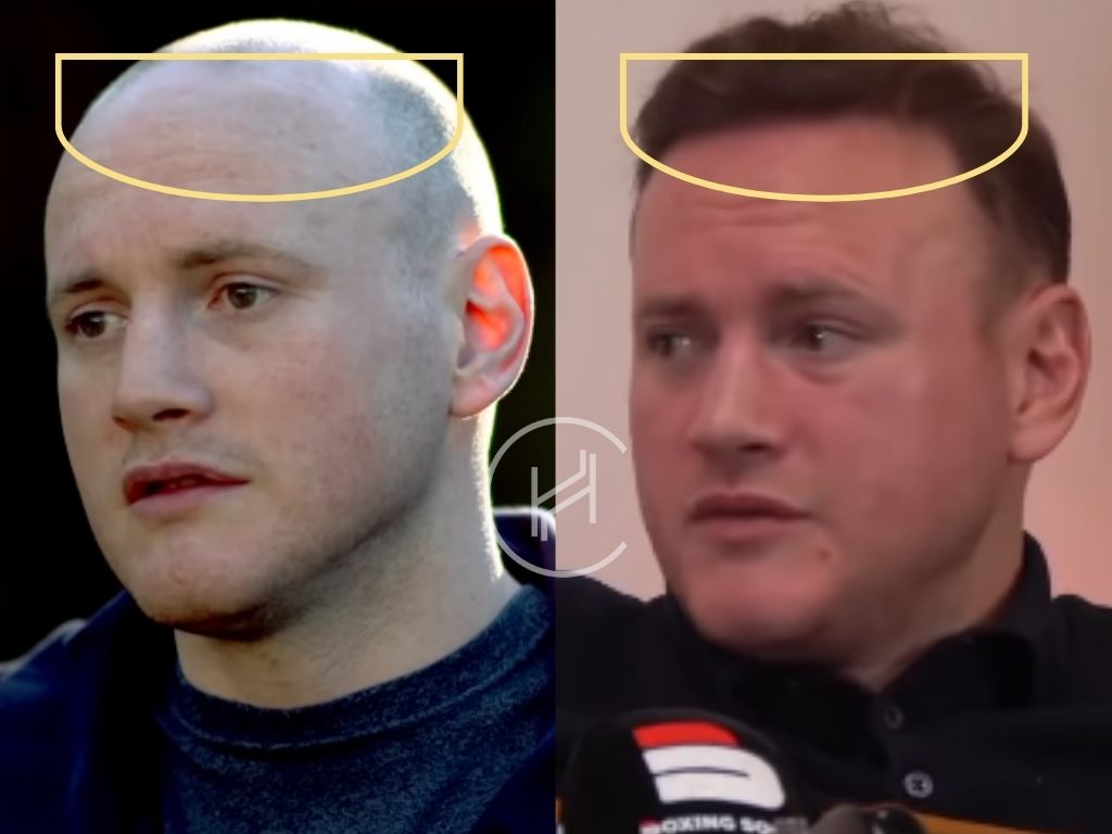george groves hair transplant before and after