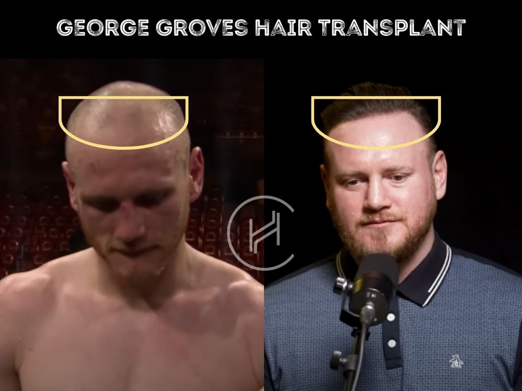 george groves - hair transplant before and after result