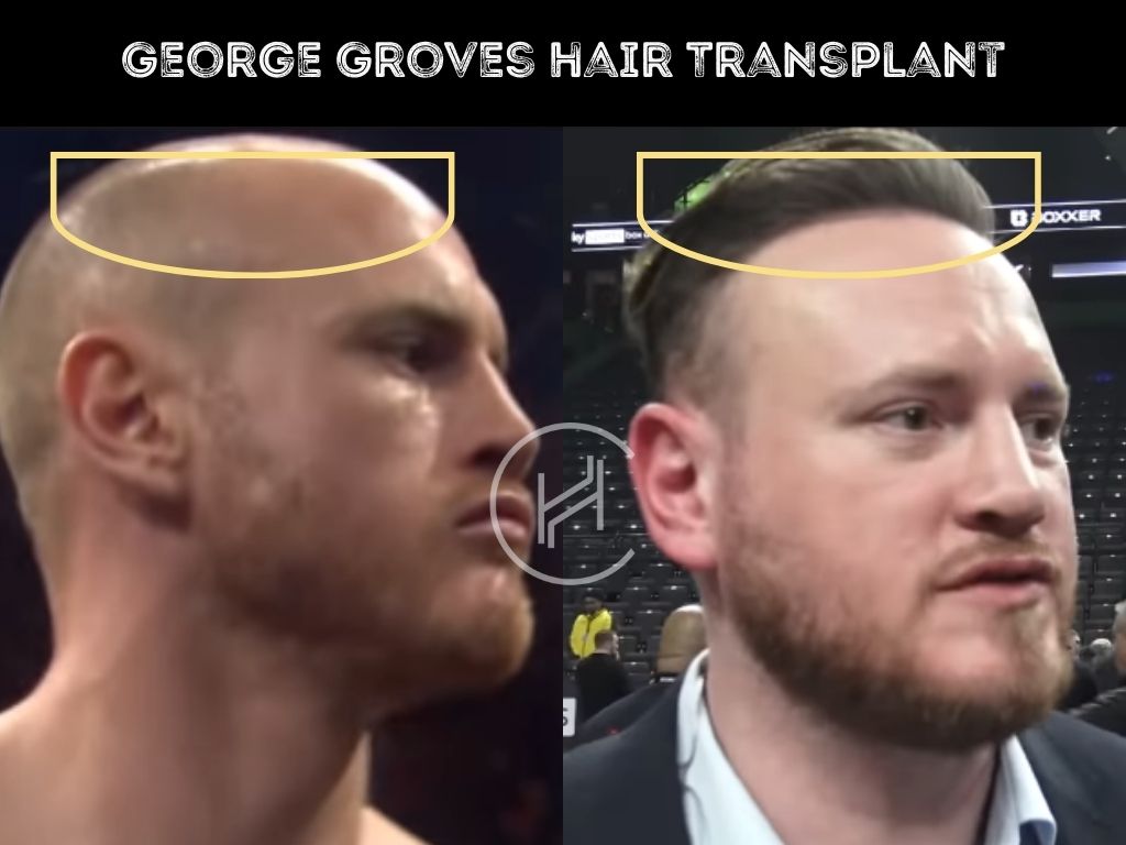 george groves - hair transplant before and after
