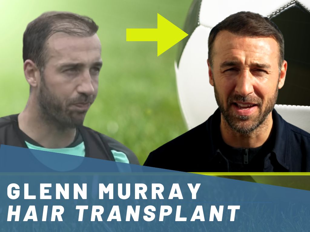 glenn murray hair transplant analysis banner