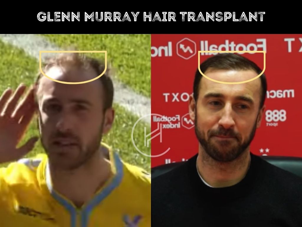 glenn murray hair transplant before after result