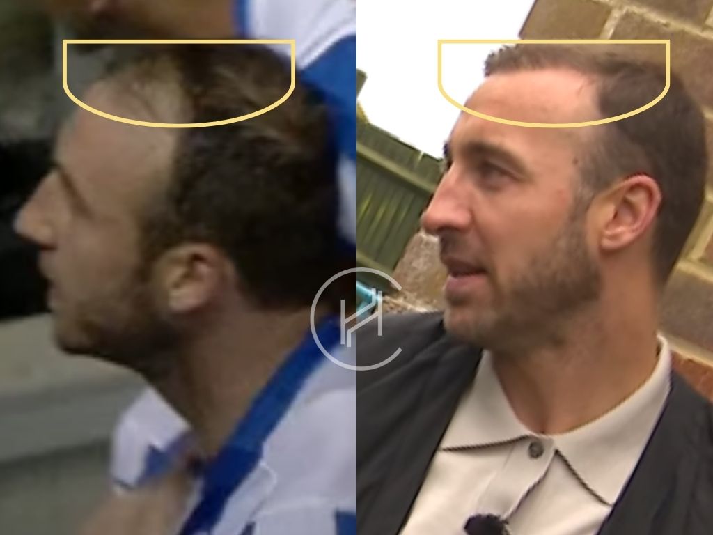 glenn murray - hair transplant before and after