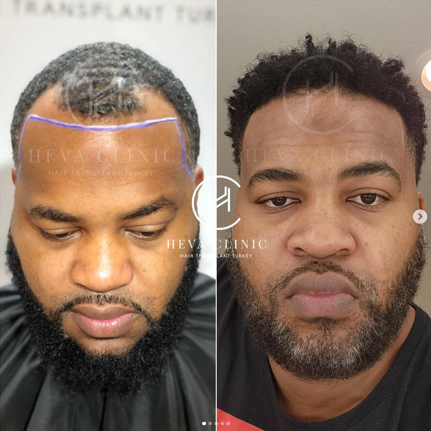 norwood 3 afro hairline transplant before and after
