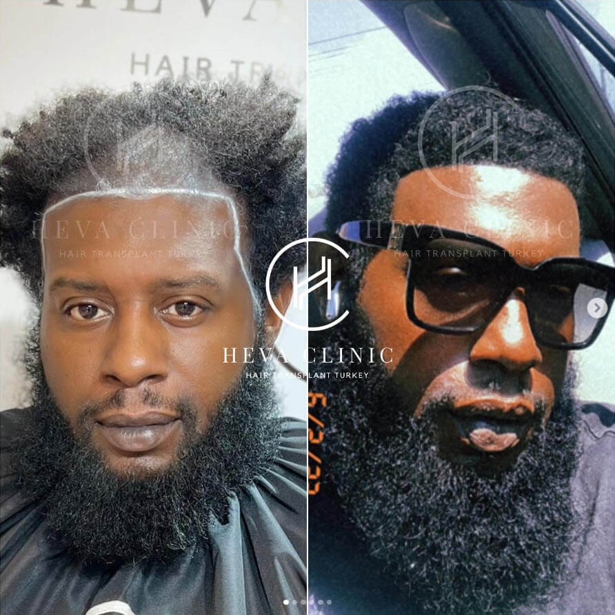 4000 grafts afro hair transplant before & after picture