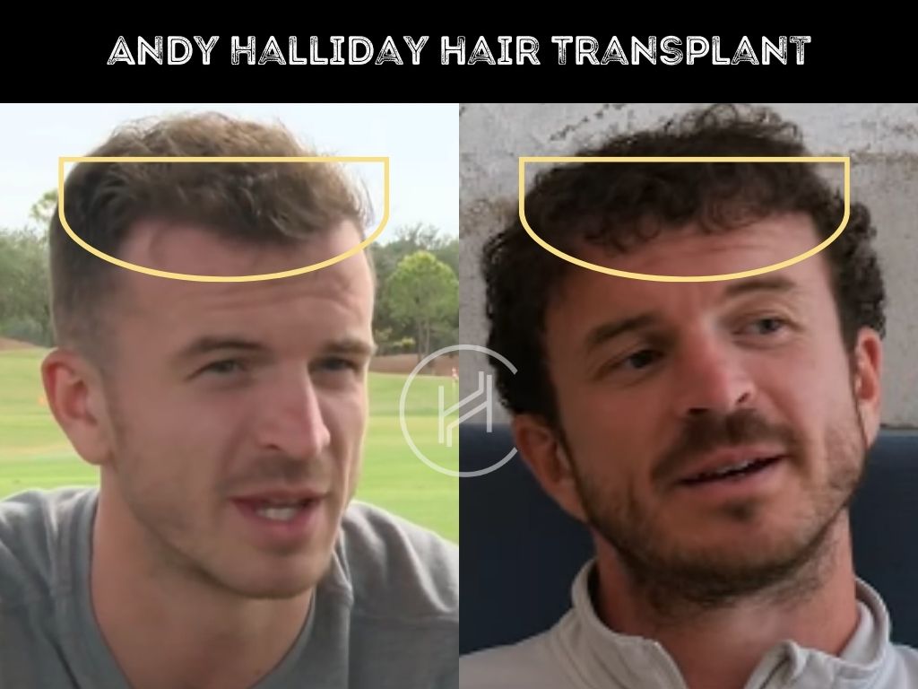 andy halliday - hair transplant before after result
