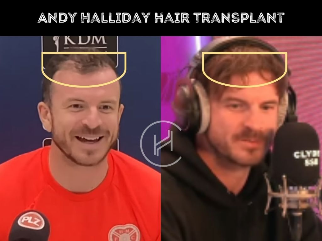 andy halliday - hair transplant before after