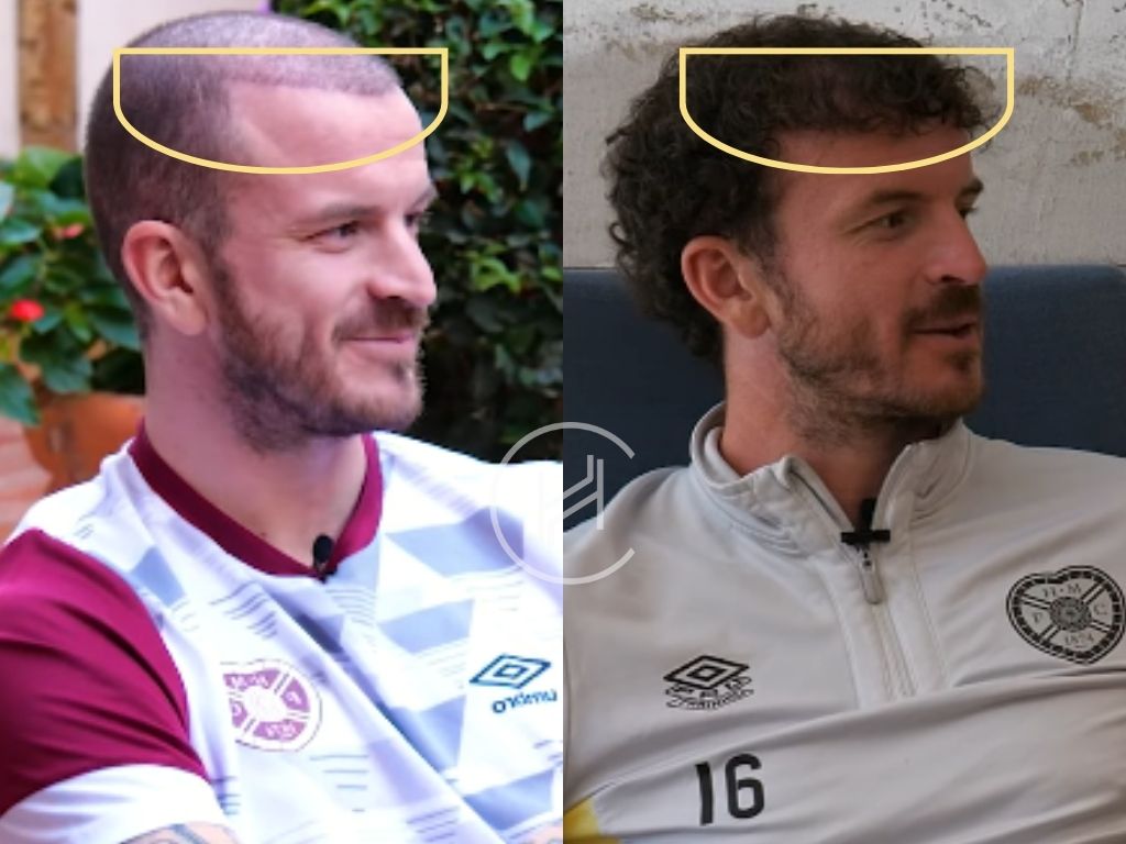 andy halliday - hair transplant before and after result