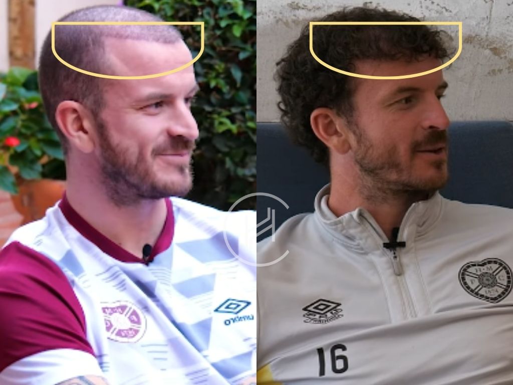 andy halliday - hair transplant before and after result