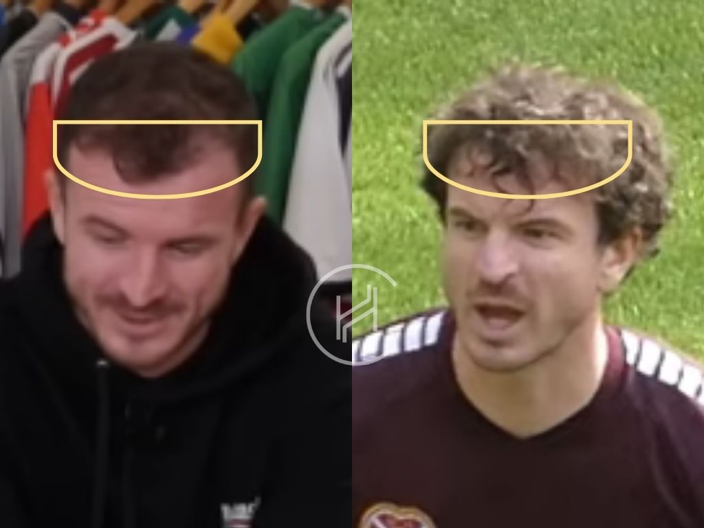 andy halliday - hair transplant before and after