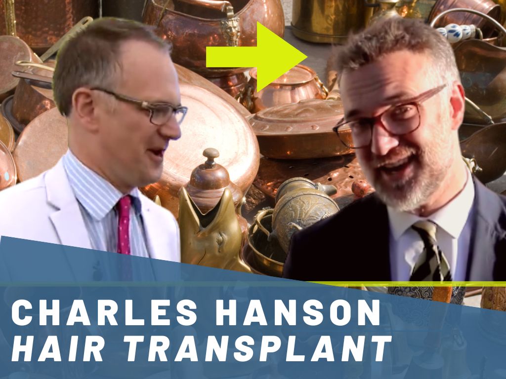 charles hanson - hair transplant analysis banner