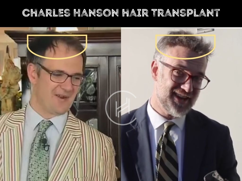 charles hanson - hair transplant before after result