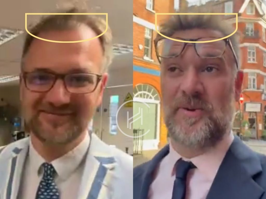 charles hanson hair transplant before and after result