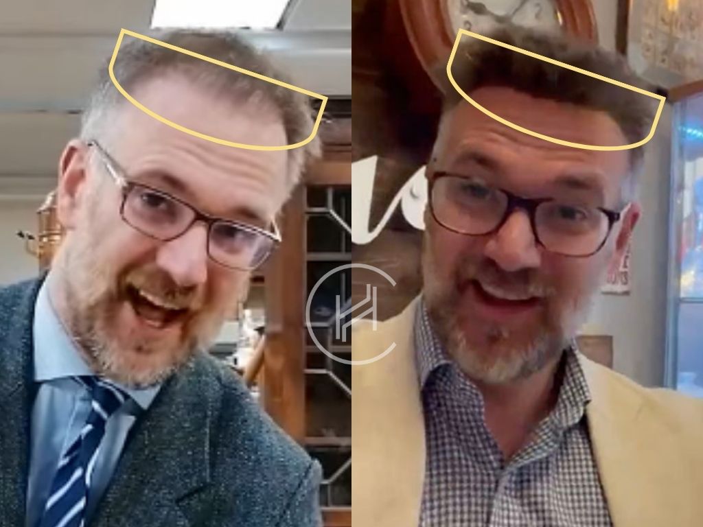 charles hanson - hair transplant before and after
