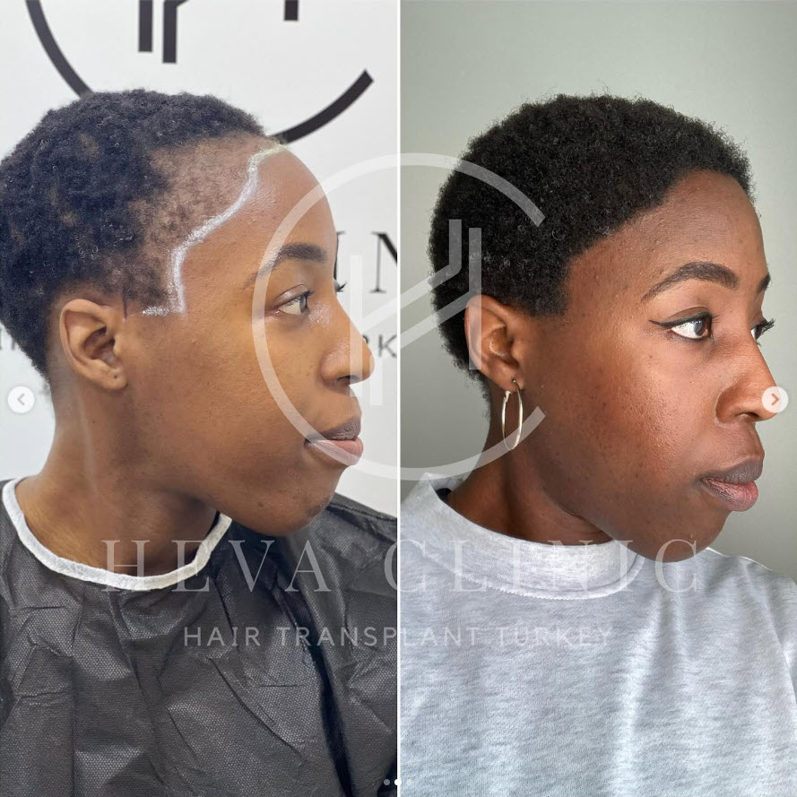 female afro hair transplant before and after sides