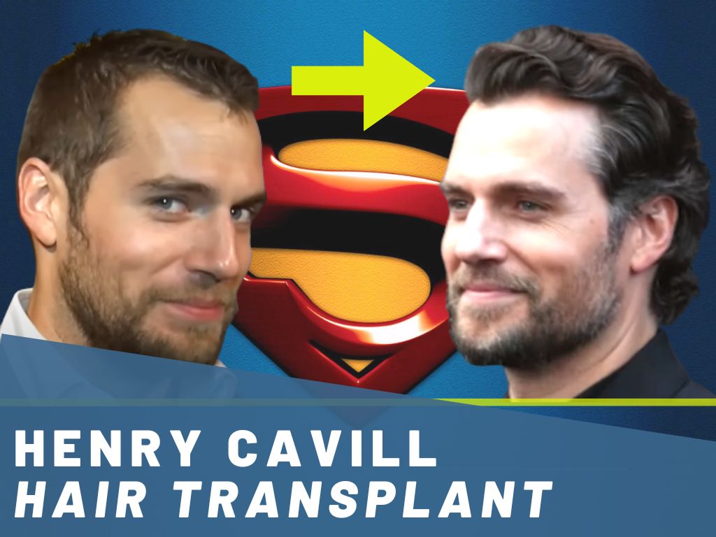 henry cavill - hair transformation