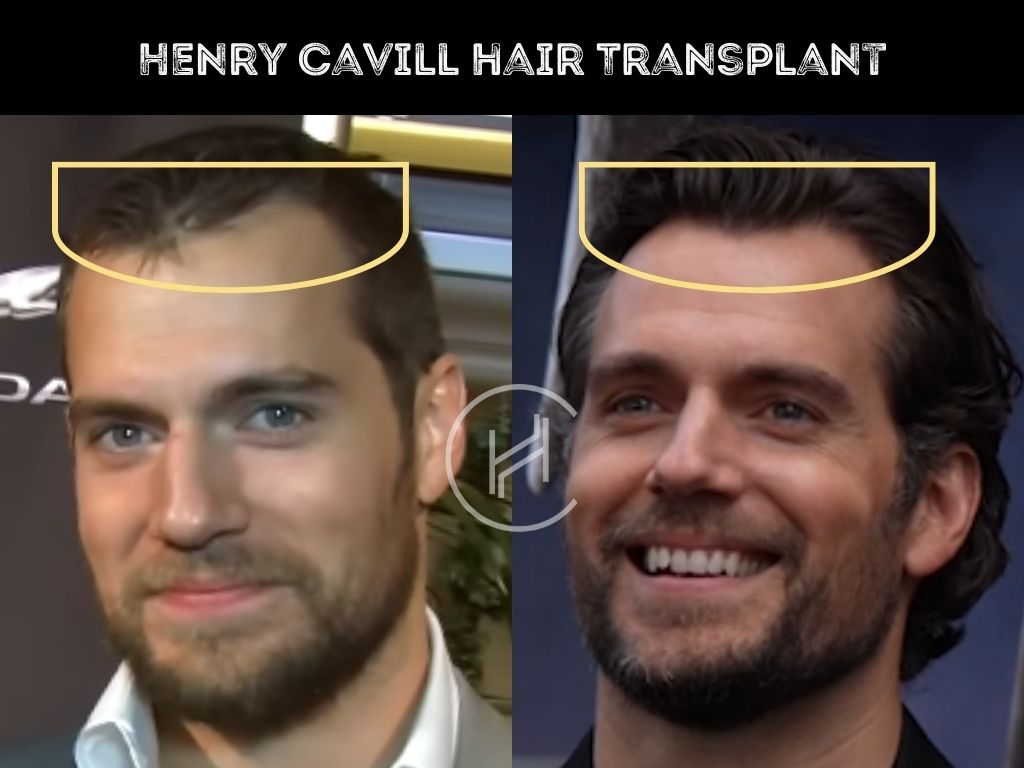 henry cavill - hair transplant before after result