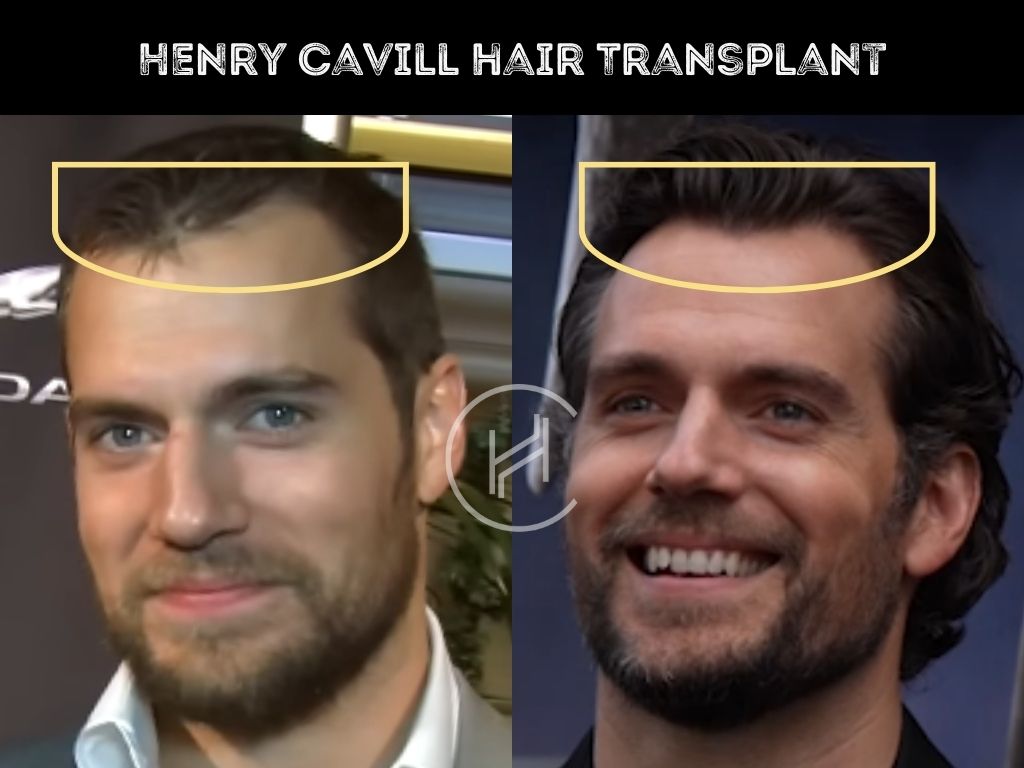 Henry Cavill Hair Transplant - Hair Loss & Technical Analysis