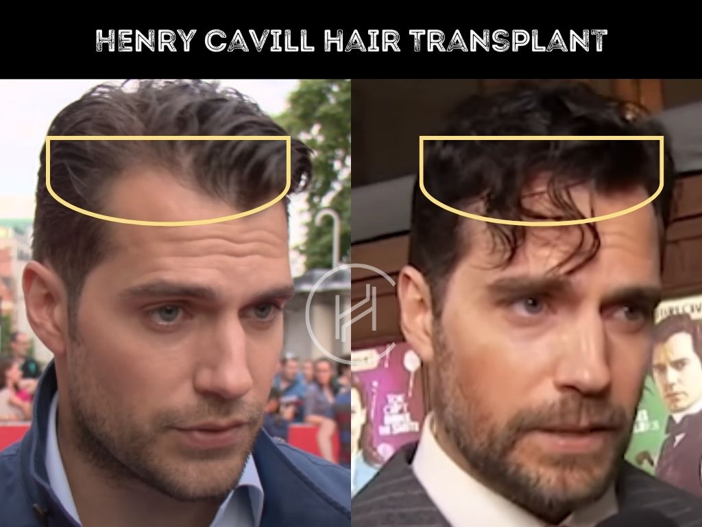 henry cavill - hair transplant before after