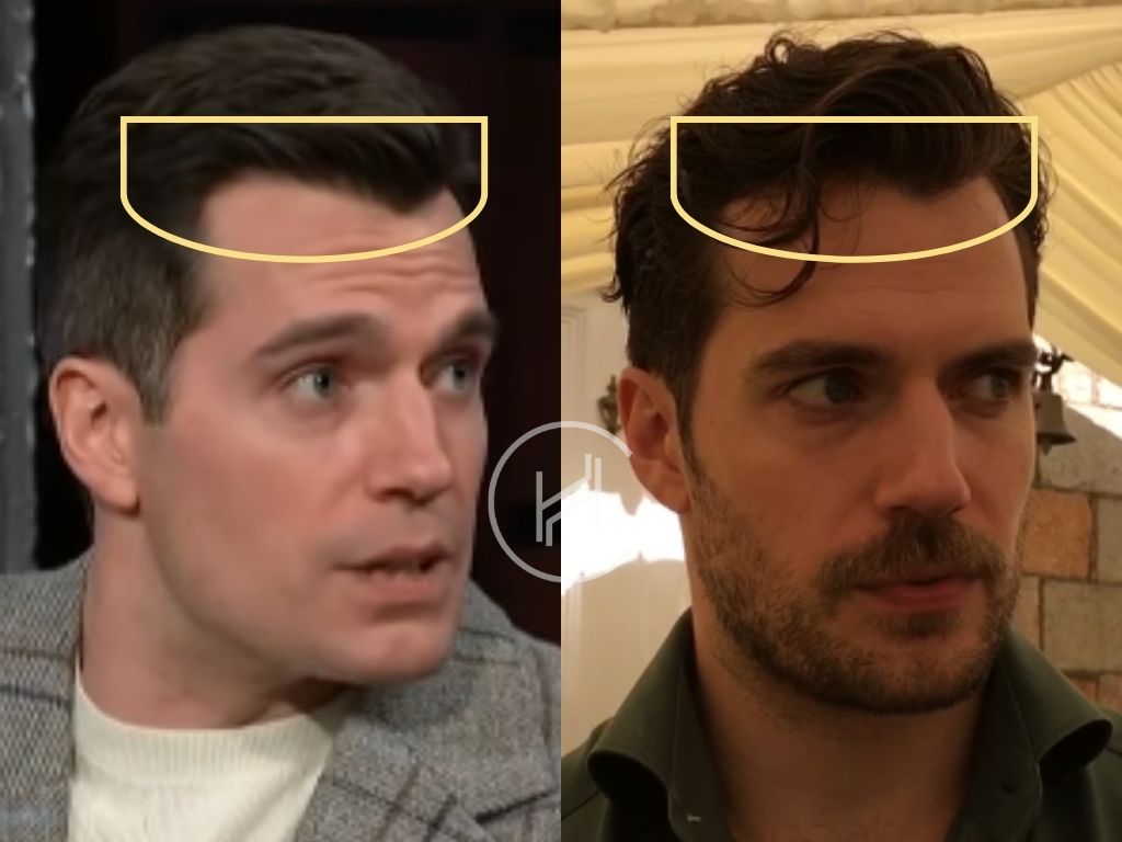 henry cavill hair transplant before and after result