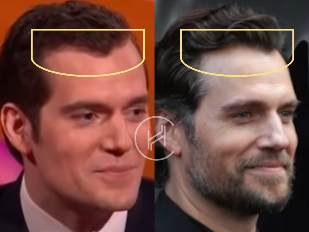 Henry Cavill Hair Transplant Hair Loss & Technical Analysis