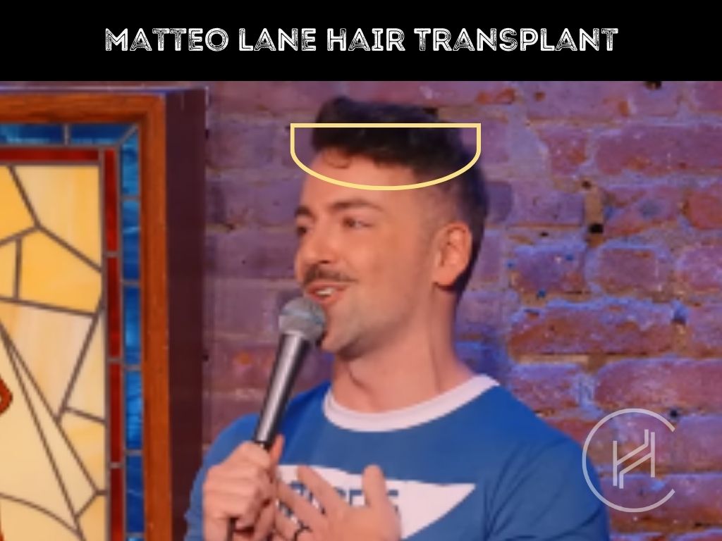 matteo lane after hair transplant
