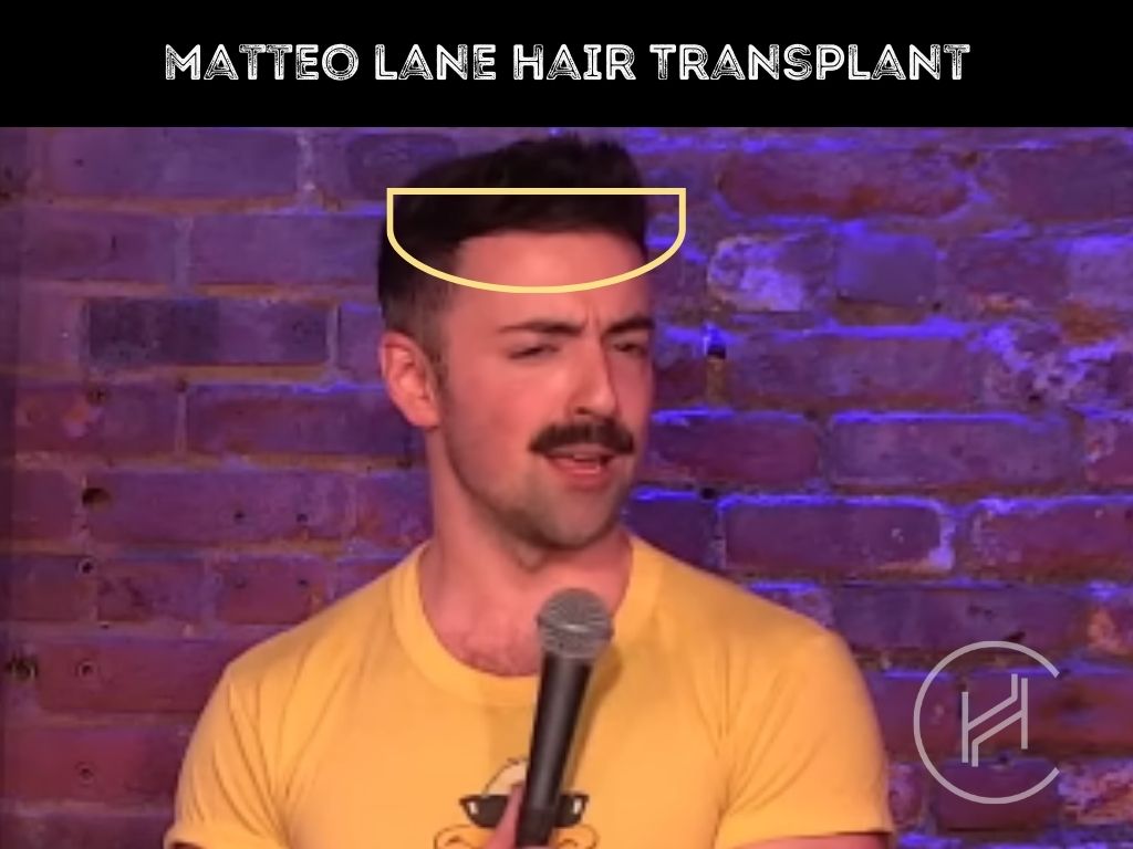 matteo lane hair transplant result frontline
