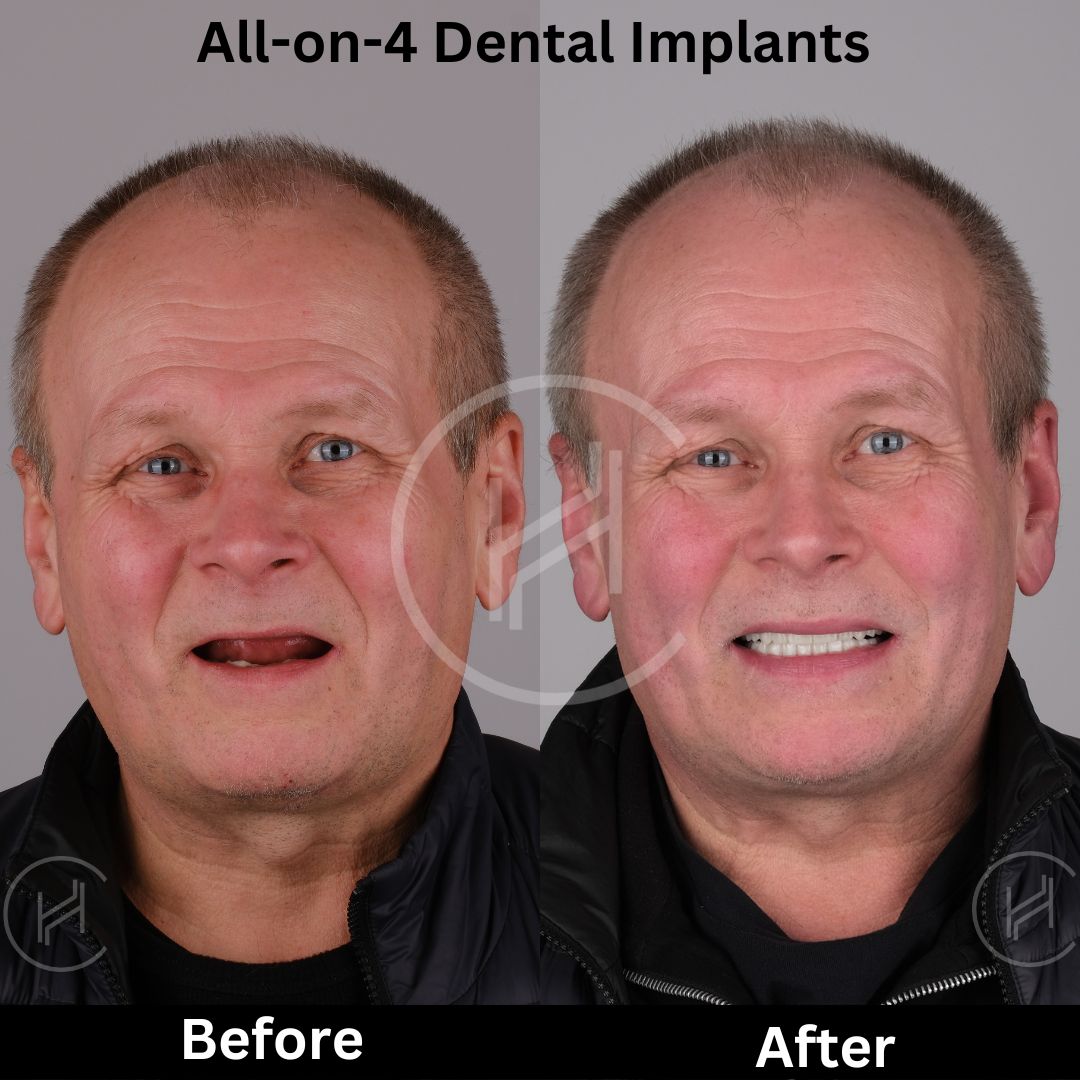 all-on-4 dental implants before after heva clinic turkey