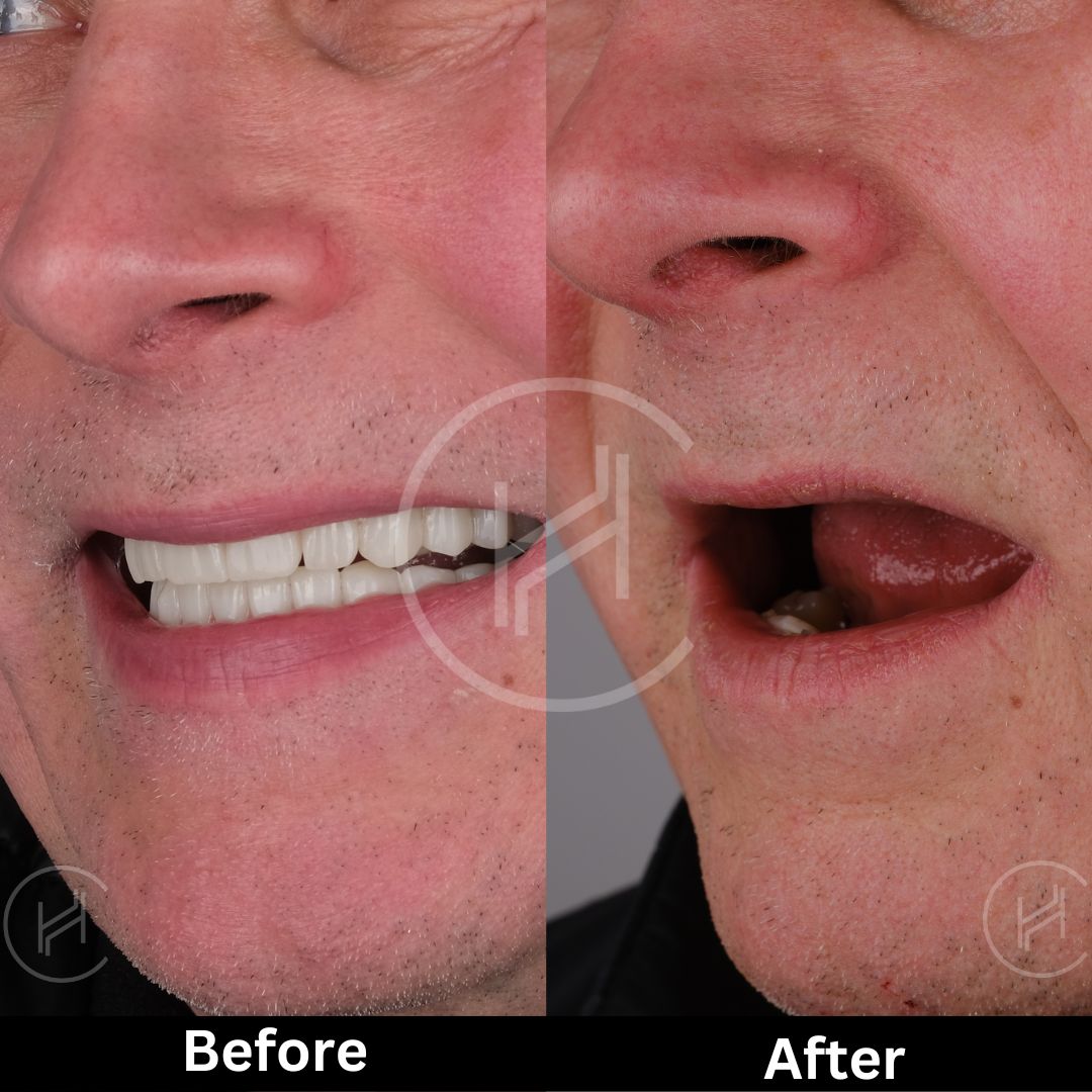 all on four dental implants before and after