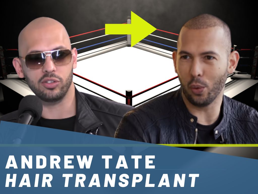 andrew tate - hair transplant analysis banner