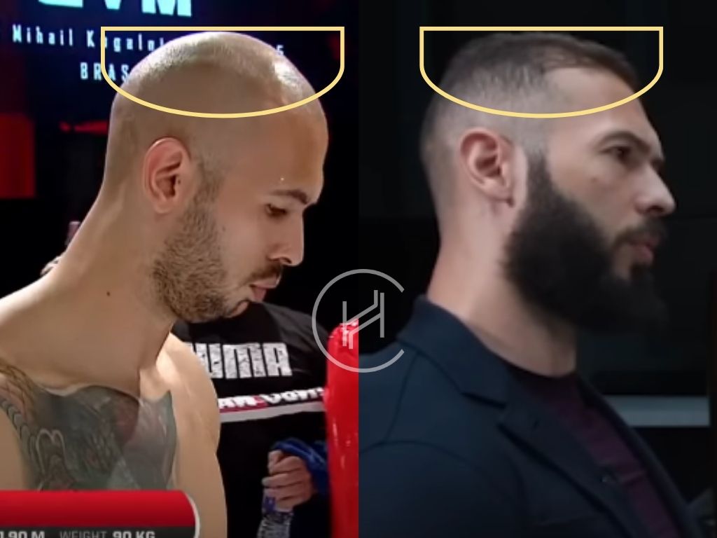 andrew tate - hair transplant before after result